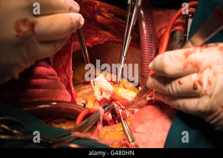 Bentall Operation in aufsteigender Aortenaneurysma Stockfoto