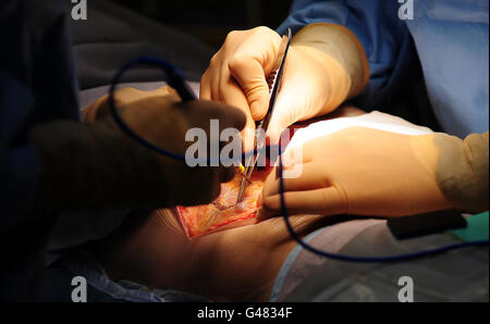 Ein generisches Stockfoto einer Operation, die im Queen Elizabeth Hospaital, Birmingham, stattfindet. Stockfoto