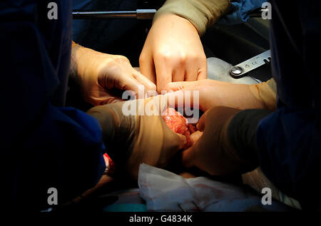 Ein generisches Stockfoto einer Operation, die im Queen Elizabeth Hospaital, Birmingham, stattfindet. Stockfoto