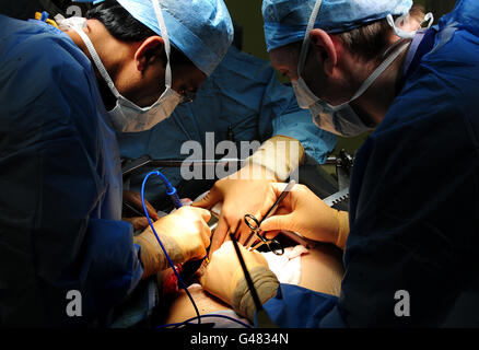 Ein generisches Stock-Foto einer Operation im Queen Elizabeth Hospital, Birmingham. Stockfoto