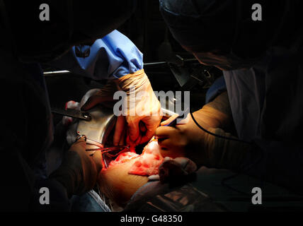 Ein generisches Stockfoto einer Operation, die im Queen Elizabeth Hospaital, Birmingham, stattfindet. Stockfoto