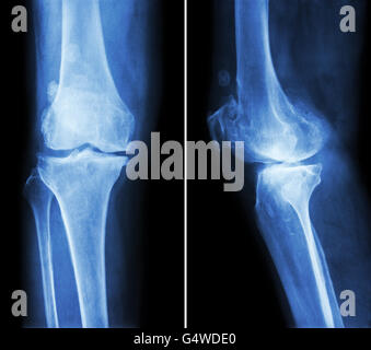 Arthrose Knie.  Filmschau Röntgen Knie (anterior - posterior und lateral View) schmale Gelenkspalt, Osteophyten (Spur) Stockfoto