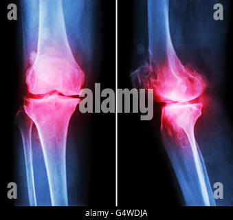 Arthrose Knie.  Filmschau Röntgen Knie (anterior - posterior und lateral View) schmale Gelenkspalt, Osteophyten (Spur) Stockfoto