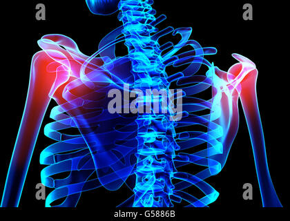 3D Illustration, Schulter schmerzhaft Skelett Röntgen, medizinisches Konzept. Stockfoto