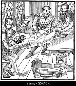 Medizin, Chirurgie, Hernie, Holzschnitt, aus: Caspar Stromayr (+ 1566 / 1567), 'Practica copiosa', 1566, Additional-Rights-Clearences-not available Stockfoto