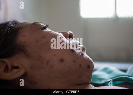 Die Erwachsene Frau, die in die Fundação de Medicina Tropical do Amazonas in Manaus, Brasilien, aufgenommen wurde, weist den charakteristischen Masern-Ausschlag auf – rote makulopapulöse Flecken, die im Gesicht beginnen und sich über den Körper ausbreiten. Diese hoch ansteckende, durch die Luft übertragene Virusinfektion unterstreicht die entscheidende Notwendigkeit einer robusten Impfversorgung und verstärkter Maßnahmen im Bereich der öffentlichen Gesundheit im Amazonasgebiet. Stockfoto