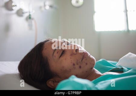 Die Erwachsene Frau, die in die Fundação de Medicina Tropical do Amazonas in Manaus, Brasilien, aufgenommen wurde, weist den charakteristischen Masern-Ausschlag auf – rote makulopapulöse Flecken, die im Gesicht beginnen und sich über den Körper ausbreiten. Diese hoch ansteckende, durch die Luft übertragene Virusinfektion unterstreicht die entscheidende Notwendigkeit einer robusten Impfversorgung und verstärkter Maßnahmen im Bereich der öffentlichen Gesundheit im Amazonasgebiet. Stockfoto