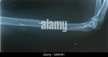 Bionischen Arm - Southampton General Hospital Stockfoto