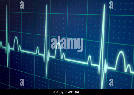 Flatline Ausrutscher auf einer medizinischen Herzmonitor ECG / EKG (Elektrokardiogramm) mit blauem Hintergrund Stockfoto