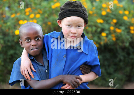 Albino-Mädchen (12 Jahre, rechts) und ein schwarzer Junge (8) in einem Dorf in Ruanda, Afrika Stockfoto