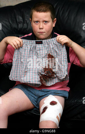 Adam Patrick Boyd, 10, aus West Denton in Newcastle, zeigt seine beschädigten Boxershorts, nachdem er von einem Staffordshire-Bullterrier-Typ-Hund angegriffen wurde. Stockfoto