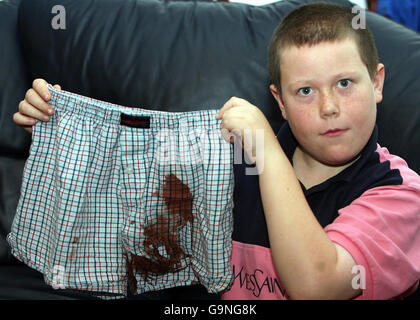 Adam Patrick Boyd, 10, aus West Denton in Newcastle, zeigt seine beschädigten Boxershorts, nachdem er von einem Staffordshire-Bullterrier-Typ-Hund angegriffen wurde. Stockfoto