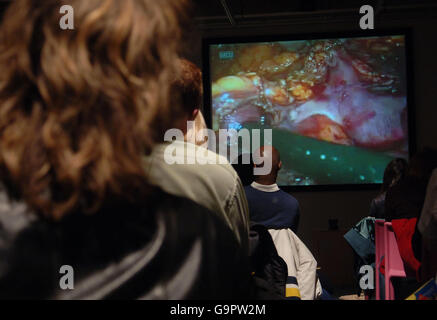 Besucher des Dana Center in London, das nur für Erwachsene zugänglich ist, sehen sich die erste Live-Übertragung von Nierentransplantationen aus dem Saint Barnabas Medical Center in New Jersey in den Vereinigten Staaten an. Stockfoto