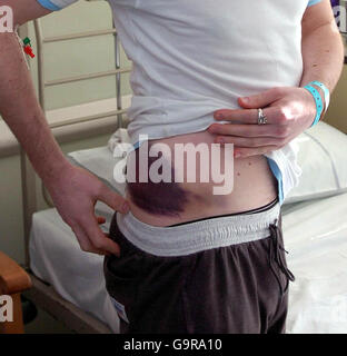 Der 28-jährige Graeme Stuart im Preston Royal Hospital. Stockfoto