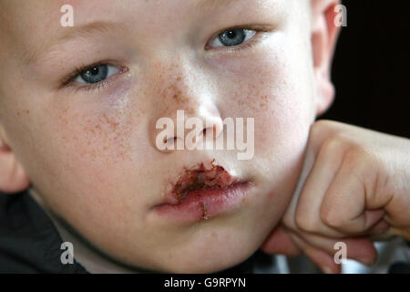 Hund beißt jungen lip Stockfoto