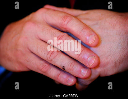 Premierminister Gordon Browns Hände zeigen während einer Pressekonferenz mit dem Präsidenten der Republik Zypern, Demetris Christofias (ungesehen), in der Downing Street 10 in London, gebissene Fingernägel. Stockfoto