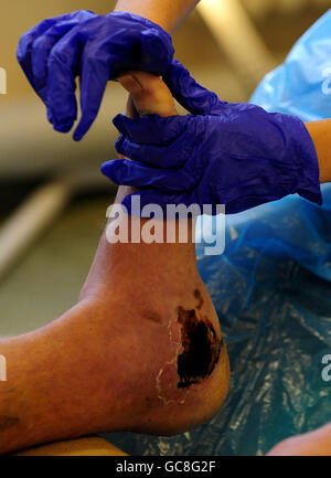 Ein verletzter Militärangehöriger während einer Physiotherapie im Selly Oak Hospital in Birmingham. Stockfoto