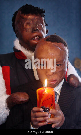 Sizwe Hlope (rechts), die als Kind schwer verbrannt wurde, und die 16-jährige Dorah Mokoena, die im Alter von sechs Monaten schwer verbrannt wurde, helfen beim Start einer Weihnachts-Brandschutzkampagne. Im Londoner Feuerwehrhauptquartier. Mit 1,300 Hausbränden pro Jahr, die durch Kerzen in Großbritannien verursacht werden, zielt die Kampagne "so schön, so tödlich" darauf ab, die Gefahren des Leuchtes von Kerzen zu Hause aufzuzeigen. Stockfoto