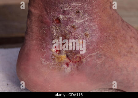 Medizinische Bild: Cellulitis Infektion auf der Haut einen Knöchel verursacht durch Venenentzündungen und Blutgerinnsel in den Venen. Stockfoto