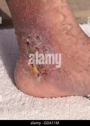 Medizinische Bild: Cellulitis Infektion auf der Haut einen Knöchel verursacht durch Venenentzündungen und Blutgerinnsel in den Venen. Stockfoto