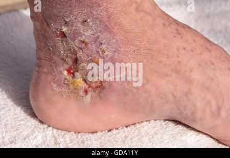 Medizinische Bild: Cellulitis Infektion auf der Haut einen Knöchel verursacht durch Venenentzündungen und Blutgerinnsel in den Venen. Stockfoto