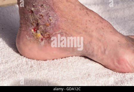 Medizinische Bild: Cellulitis Infektion auf der Haut einen Knöchel verursacht durch Venenentzündungen und Blutgerinnsel in den Venen. Stockfoto