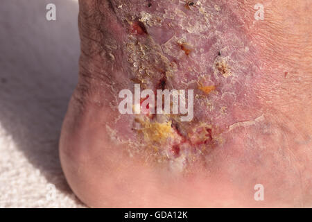 Medizinische Bild: Cellulitis Infektion auf der Haut einen Knöchel verursacht durch Venenentzündungen und Blutgerinnsel in den Venen. Stockfoto
