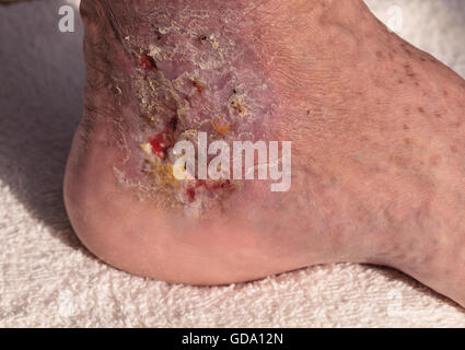 Medizinische Bild: Cellulitis Infektion auf der Haut einen Knöchel verursacht durch Venenentzündungen und Blutgerinnsel in den Venen. Stockfoto