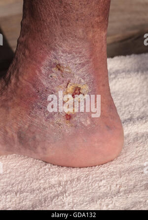 Medizinische Bild: Cellulitis Infektion auf der Haut einen Knöchel verursacht durch Venenentzündungen und Blutgerinnsel in den Venen. Stockfoto