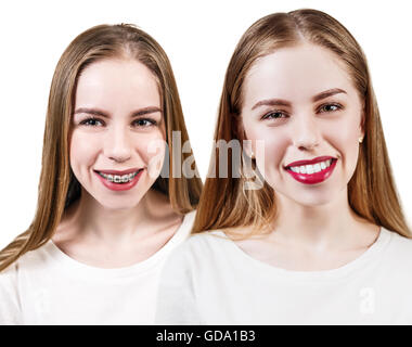 Perfekte Zähne vor und nach der geschweiften Klammern Stockfoto