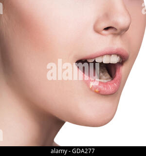 Schöne Lippen-infizierten Herpes-virus Stockfoto