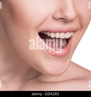 Schöne Lippen-infizierten Herpes-virus Stockfoto