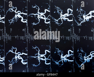 MRI Scan-Kopf, Blutgefäße im Gehirn Stockfoto