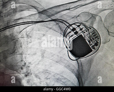 Herzschrittmacher bei Herzkrankheiten. Farbige Röntgenaufnahme zeigt
