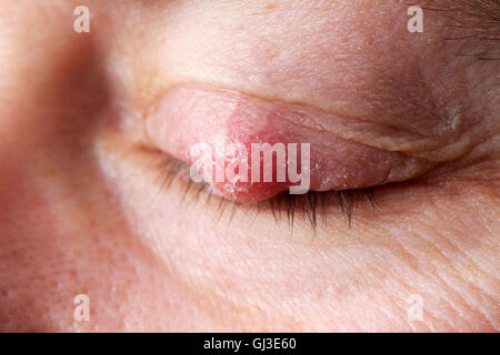 Chalazion im Oberlid.  Ein Chalazion, auch bekannt als eine Meibom-Drüse Lipogranuloma, ist eine Zyste im Augenlid, das b verursacht wird Stockfoto