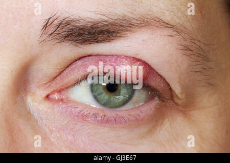 Chalazion im Oberlid.  Ein Chalazion, auch bekannt als eine Meibom-Drüse Lipogranuloma. Stockfoto