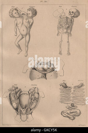 Siamesische Zwillinge: 'Monstruosités' II. Siamesische Zwillinge, antiken Drucken 1834 Stockfoto
