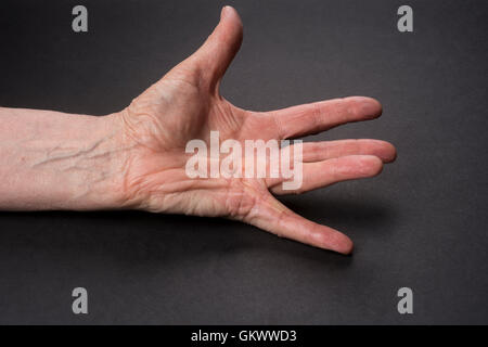 Der Dupuytren'schen Kontraktur oder Syndrom der Ringfinger der linken Hand. Stockfoto