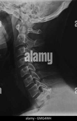 Hals und Nacken Röntgen-Scan einen 42 Jahre alten männlichen Erwachsenen. Halswirbel Anatomie. Stockfoto