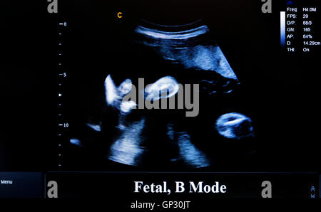 Moderne Echokardiographie (Ultraschall) Maschine Monitor. Farbbild. Neue Hospitl-Ausrüstung für eine bessere Diagnostik. Fetale B-Modus Stockfoto