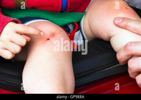 Kleinkind mit geschnittenen Knie Stockfoto