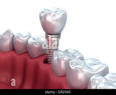 Zahnimplantat, medizinisch genaue 3D-Illustration Stockfoto