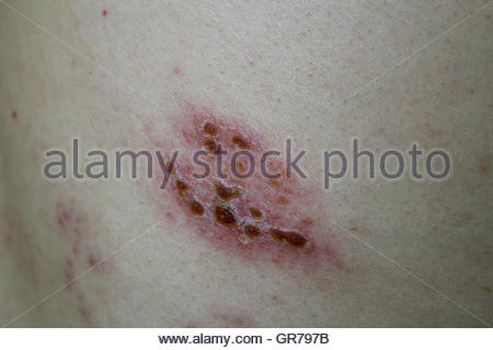 Herpes Zoster Gürtelrose Hautausschlag Stockfoto, Bild: 3217471 - Alamy