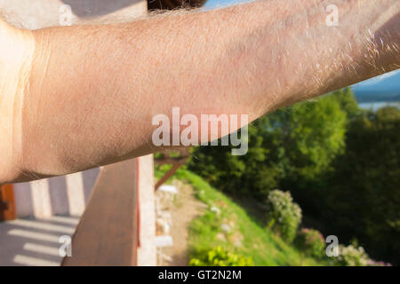 Der erhabene Arm eines britischen Touristenschwimmers mit Entzündung durch das Eingraben eines "Entenflohs" ("Puces de Canard" auf Französisch). Lac du Bourget, wo der Schwimmer schwamm, ist in der Ferne zu sehen. Stockfoto