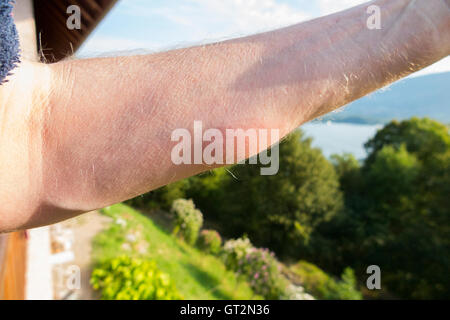 Der erhabene Arm eines britischen Touristenschwimmers mit Entzündung durch das Eingraben eines "Entenflohs" ("Puces de Canard" auf Französisch). Lac du Bourget, wo der Schwimmer schwamm, ist in der Ferne zu sehen. Stockfoto