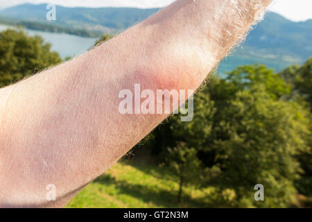 Der erhabene Arm eines britischen Touristenschwimmers mit Entzündung durch das Eingraben eines "Entenflohs" ("Puces de Canard" auf Französisch). Lac du Bourget, wo der Schwimmer schwamm, ist in der Ferne zu sehen. Stockfoto