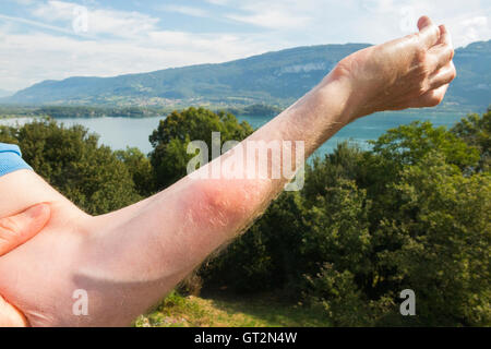 Der erhabene Arm eines britischen Touristenschwimmers mit Entzündung durch das Eingraben eines "Entenflohs" ("Puces de Canard" auf Französisch). Lac du Bourget, wo der Schwimmer schwamm, ist in der Ferne zu sehen. Stockfoto