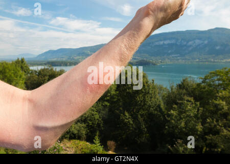 Der erhabene Arm eines britischen Touristenschwimmers mit Entzündung durch das Eingraben eines "Entenflohs" ("Puces de Canard" auf Französisch). Lac du Bourget, wo der Schwimmer schwamm, ist in der Ferne zu sehen. Stockfoto