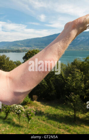 Der erhabene Arm eines britischen Touristenschwimmers mit Entzündung durch das Eingraben eines "Entenflohs" ("Puces de Canard" auf Französisch). Lac du Bourget, wo der Schwimmer schwamm, ist in der Ferne zu sehen. Stockfoto