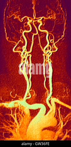 Brust, Hals und Kopf Arterien. Farbige Magnetresonanz-Angiographie (MRA) Scan eines normalen Karotis Systems ein 55 Jahre alter Mann. Unten in der Mitte ist der Aortenbogen, die Kurven über das Herz. Sind die Arterien, die aus diesen Zweigen ab: die Brachiocepha Stockfoto